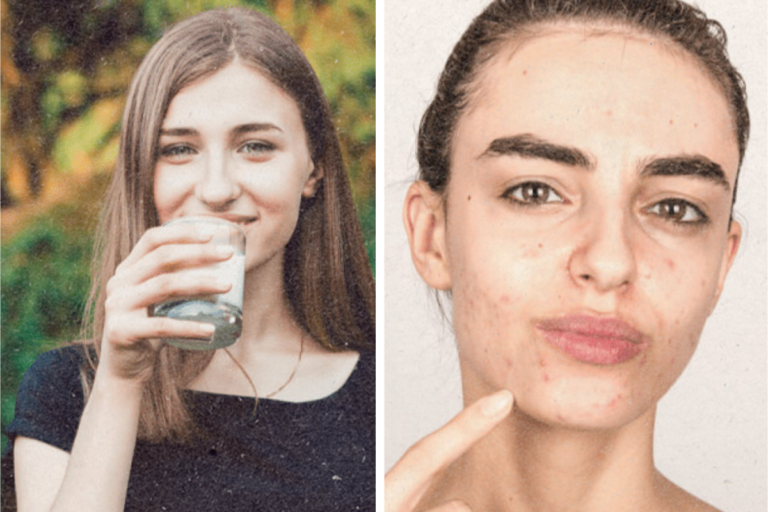 Does Dairy Trigger Acne? Exploring the Connection